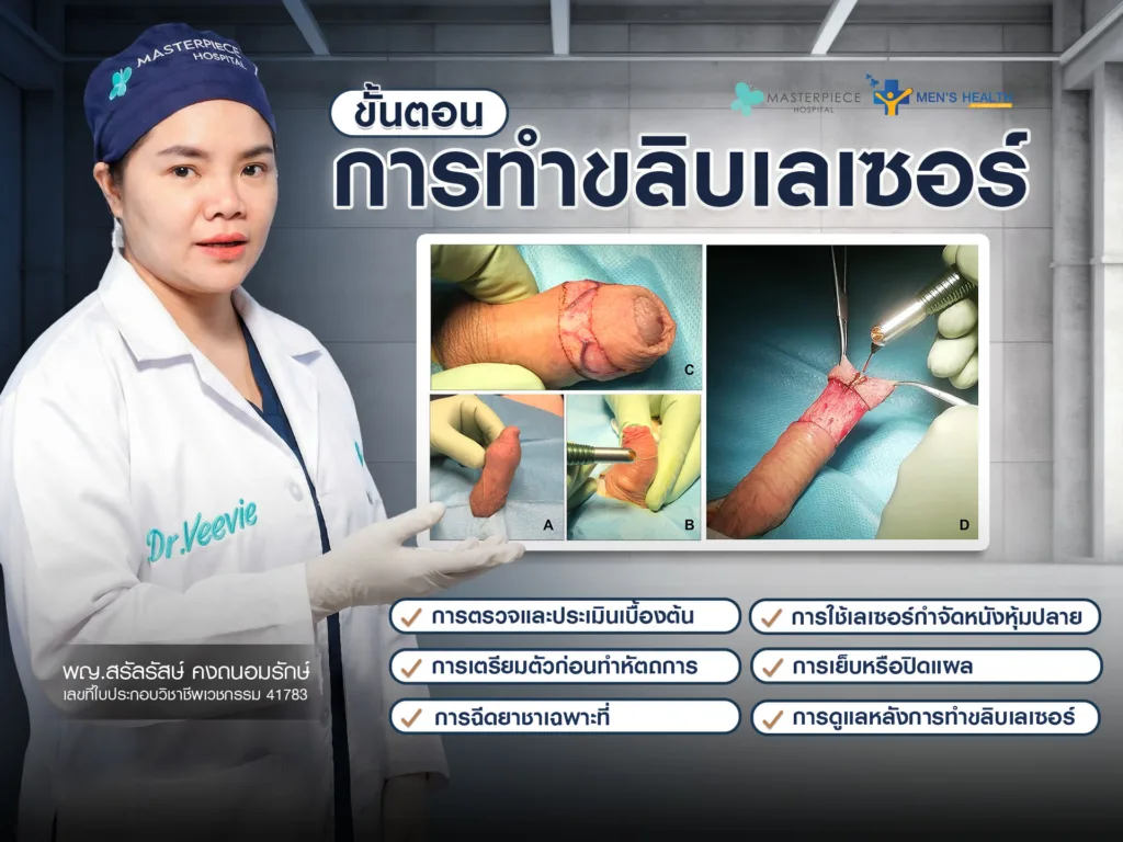 ขั้นตอนการทำขลิบเลเซอร์