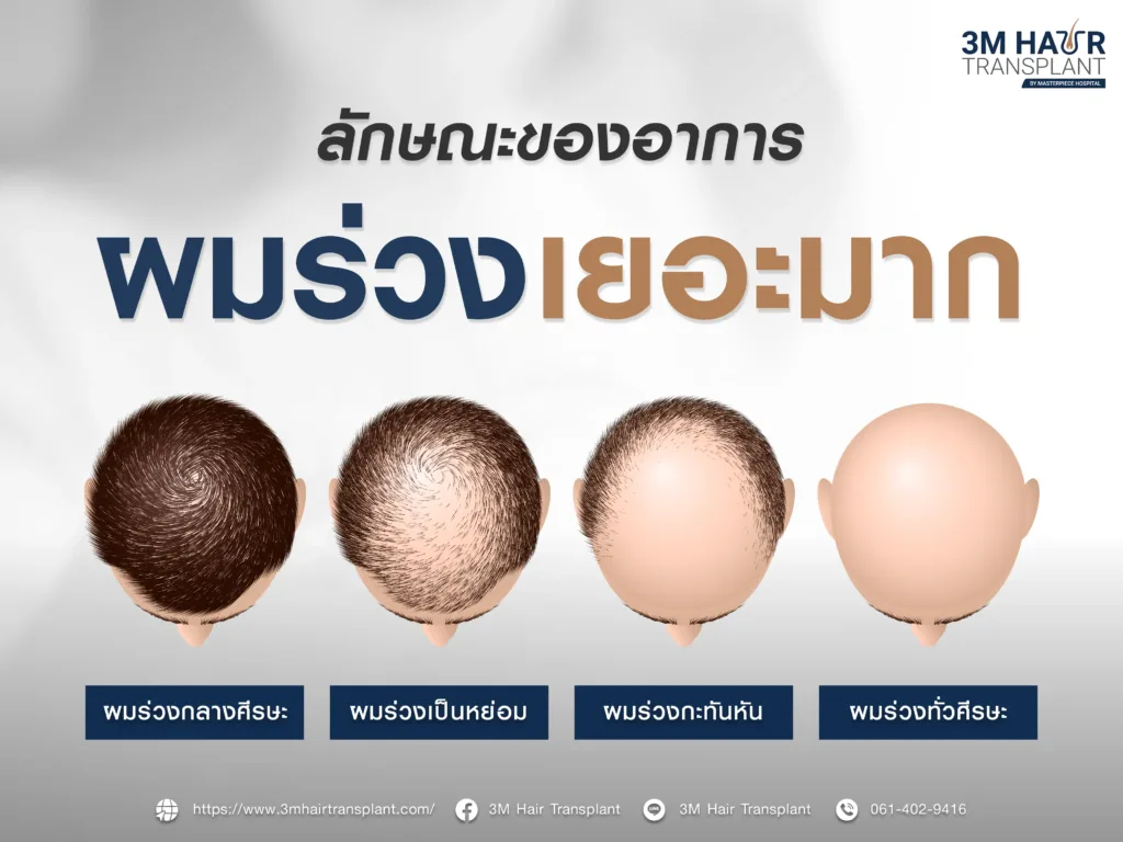 ลักษณะของอาการผมร่วงเยอะมาก