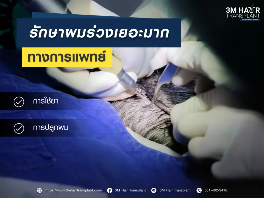 วิธีรักษาผมร่วงเยอะมาก ทางการแพทย์